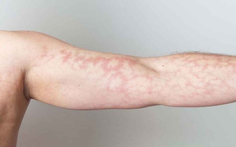 Marbrures de la peau